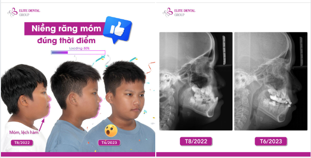 Cắn ngược ở trẻ em cần quan tâm sớm là bởi vì!