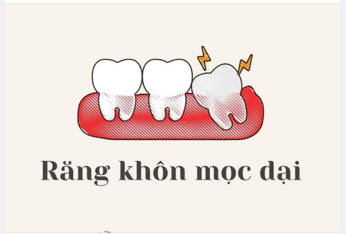 Răng khôn mọc dại