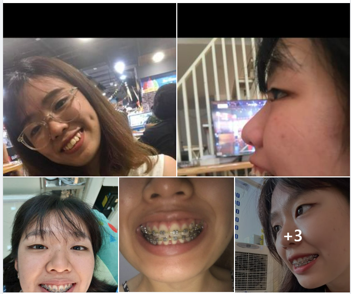 HÈ ĐẾN RỒI NIỀNG RĂNG THÔI SỰ KÌ DIỆU KHI NIỀNG RĂNG