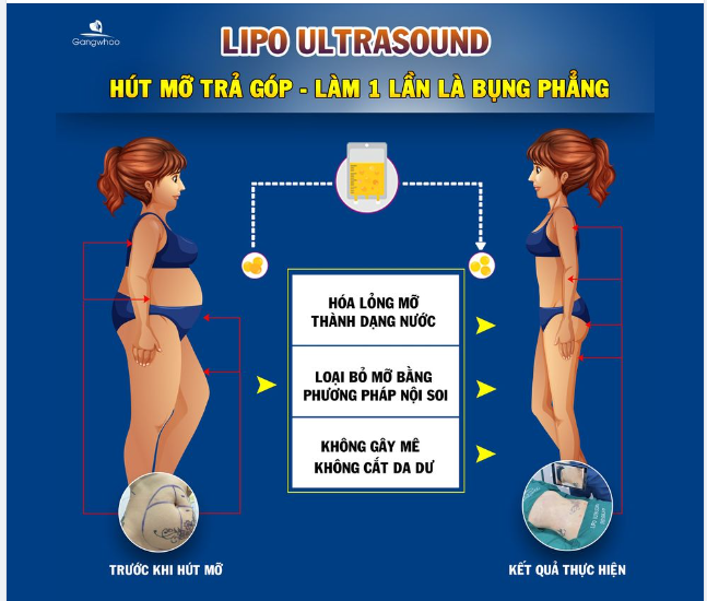 ƯU ĐIỂM LIPO ULTRASOUND LÀ GÌ MÀ CHINH PHỤC CẢ THẾ GIỚI?