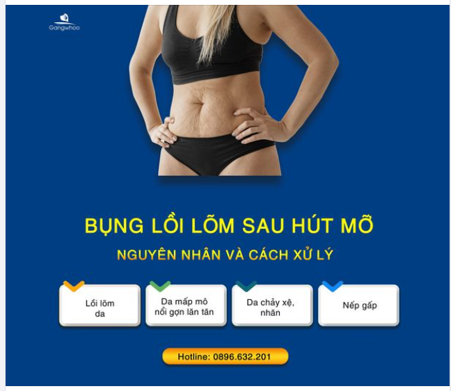 BỤNG LỒI LÕM SAU HÚT MỠ CẦN ĐƯỢC XỬ LÝ NHƯ THẾ NÀO?