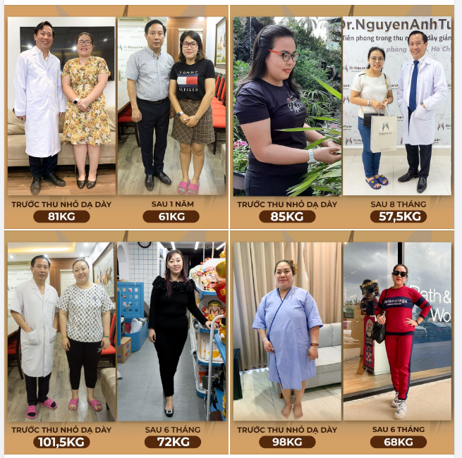 Phẫu thuật thu nhỏ dạ dày giảm béo là phương pháp loại bỏ khoảng 70 – 80% dạ dày theo phía bờ cong lớn nơi có tế bào chế tiết ra Hoocmoon Ghrelin (một loại hooc môn gây cảm giác đói, thèm ăn) tạo ra một ống dạ dày hẹp với thể tích khoảng