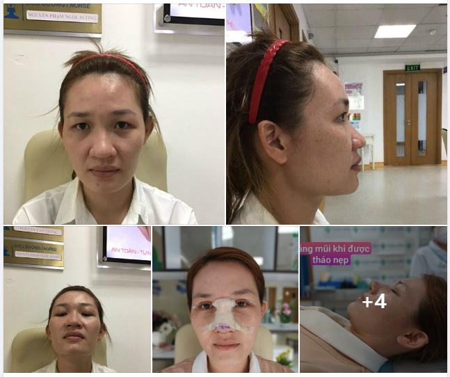 ​​​​​​​ Chị Ngọc Ánh sống tại Bến Tre. Bản thân chị trước đây, nếp mí 2 bên không rõ, bị che lấp bới da thừa và bọng mỡ nhiều.