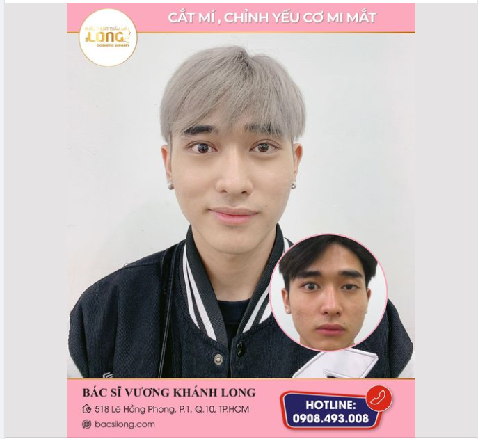 "Đẳng cấp mới của CẬU TRAI sau 30 phút cắt mí chỉnh yếu cơ!