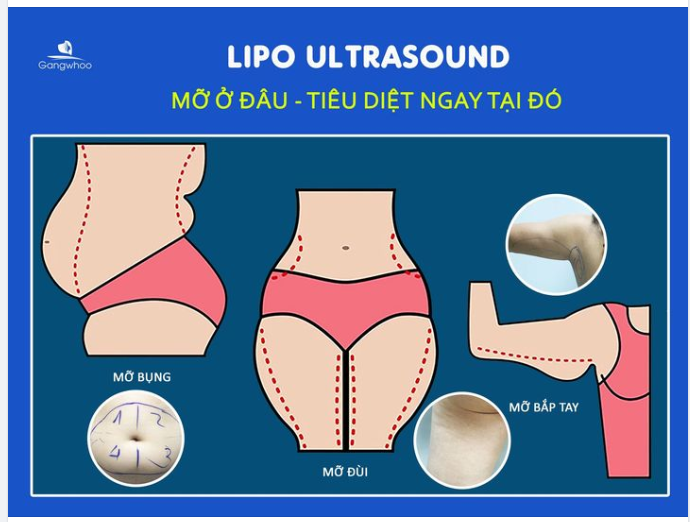 BẠN ĐANG GẶP KHÓ KHĂN VÌ MỠ VÙNG NÀO?