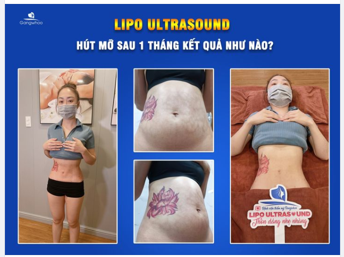 SAU 1 THÁNG HÚT MỠ, VÒNG EO BẠN SẼ NHƯ THẾ NÀO?