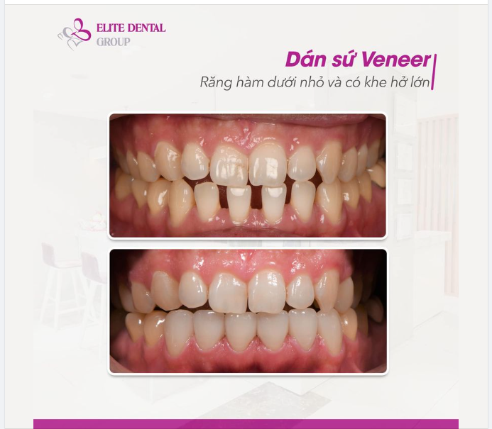 Dán sứ Veneer: khắc phục tình trạng răng cửa hàm dưới nhỏ và thưa