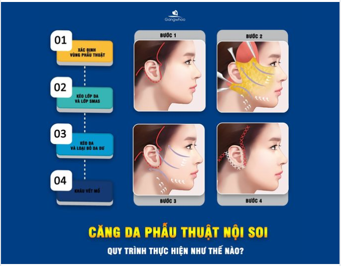 BẠN ĐÃ BIẾT 1 LẦN CĂNG DA PHẪU THUẬT NỘI SOI DIỄN RA NHƯ NÀO CHƯA?