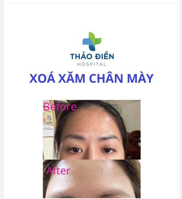 Công nghệ Xóa xăm laser hiện đại bậc nhất với bước sóng 1064nm  532nm xóa được các màu mực đen, đỏ, nâu đen, không gây tổn thương da, không để lại sẹo, Giải pháp hoàn hảo với ưu điểm vượt trội