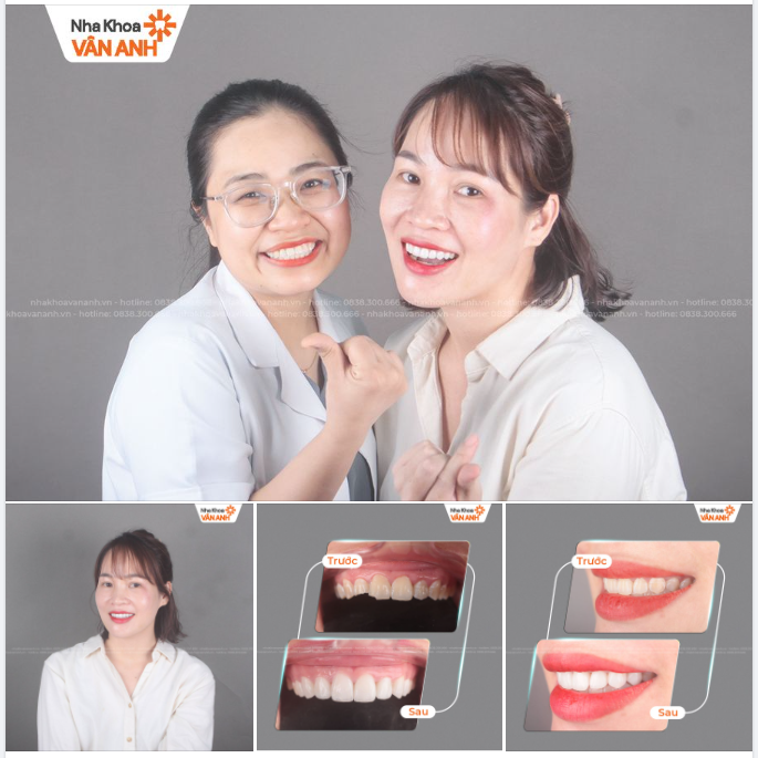 DÁN SỨ VENEER - RĂNG XINH CƯỜI ĐẸP YÊU KIỀU TỰ TIN