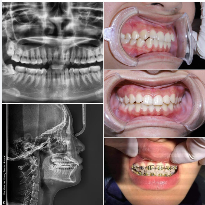 CHÚC MỪNG KHÁCH HÀNG MỚI GIA NHẬP HỘI ĐỒNG NIỀNG CÙNG NHA KHOA THÁI TỔ