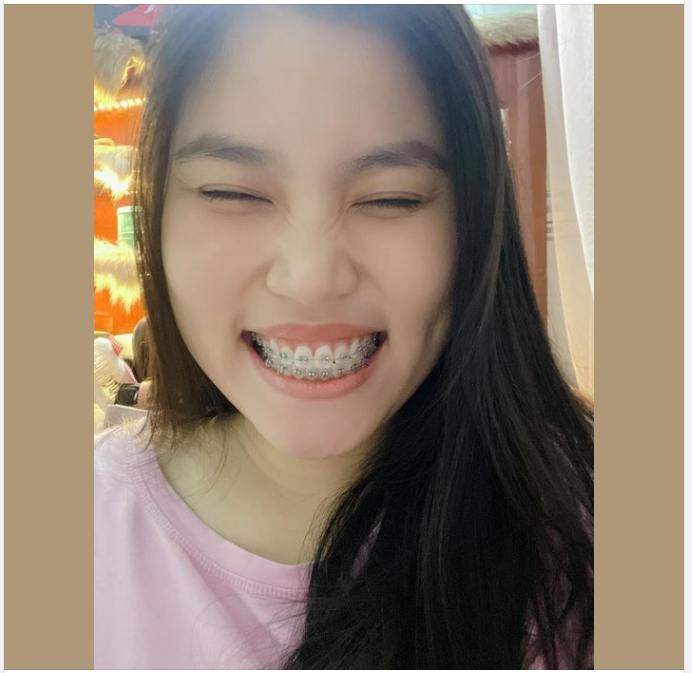 THAY ĐỔI NHỎ NHƯNG ĐẸP MÃI VỀ SAU NHỜ CHỈNH NHA