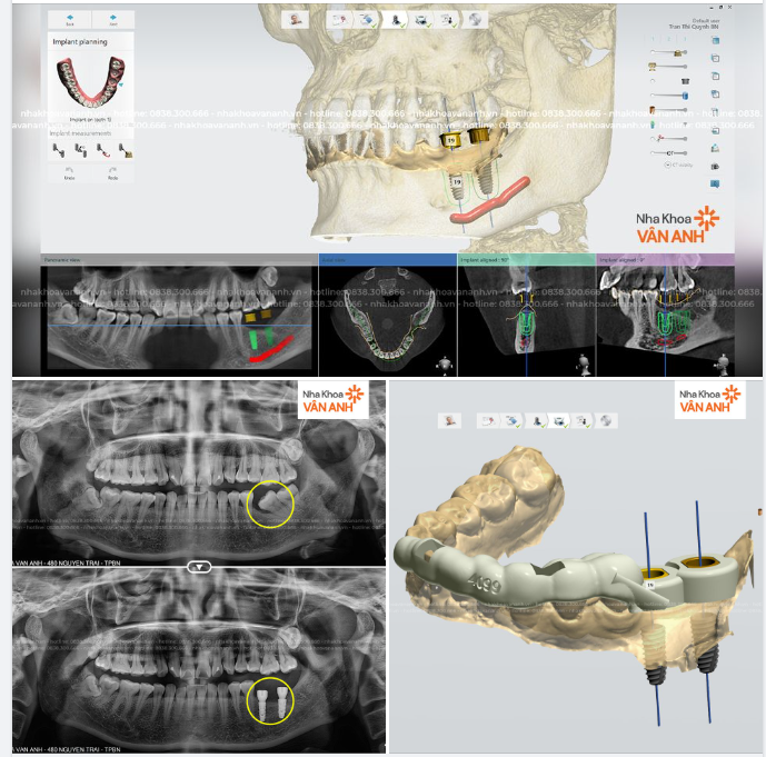 MẤT RĂNG 6 LÂU NĂM GÂY XÔ LỆCH RĂNG >> KHÔI PHỤC HOÀN TOÀN NHỜ CÔNG NGHỆ HI-SAFE IMPLANT