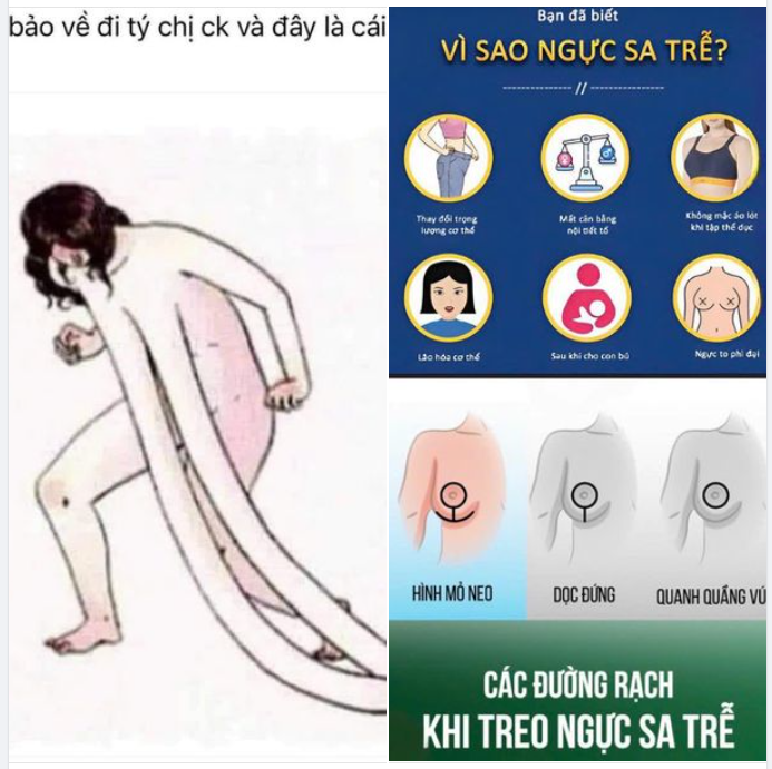 NGỰC CHẢY XỆ PHẢI LÀM SAO?