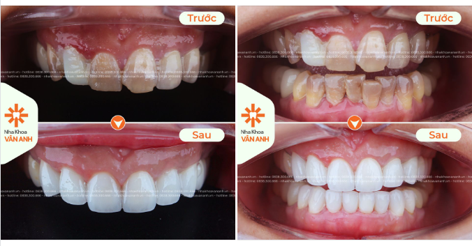 RĂNG SỨT MẺ, NHIỄM TETRACYCLINE PHẢI LÀM THẾ NÀO
