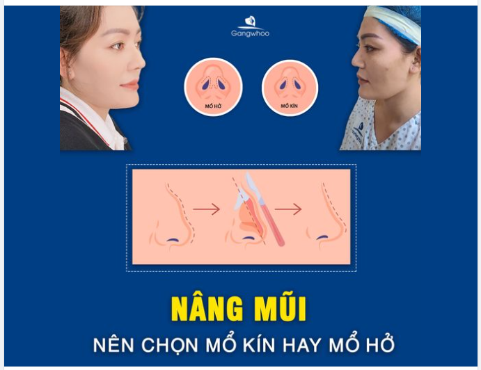 NÂNG MŨI NÊN CHỌN MỔ KÍN HAY MỔ HỞ?