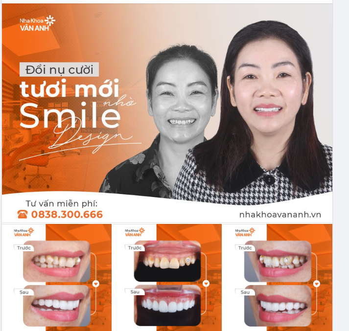 SỞ HỮU HÀM RĂNG TRẮNG SÁNG, ĐƯỜNG CƯỜI TỰ NHIÊN BỞI CÔNG NGHỆ SMILE DESIGN
