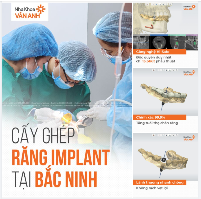 Trồng Răng Implant Chất Lượng và An Toàn - Công nghệ Hi-Safe giúp Bạn trọn niềm tin