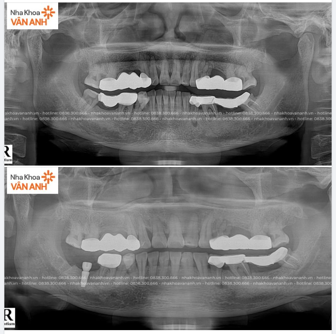 TRỒNG RĂNG IMPLANT KHẮC PHỤC CẦU RĂNG SỨ HỎNG, CẢI THIỆN ĂN NHAI