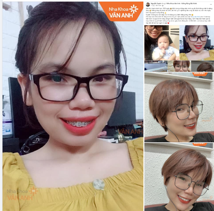 FEEDBACK SIÊU CHẤT LƯỢNG TỪ KHÁCH HÀNG THÁO NIỀNG TẠI NHA KHOA VÂN ANH