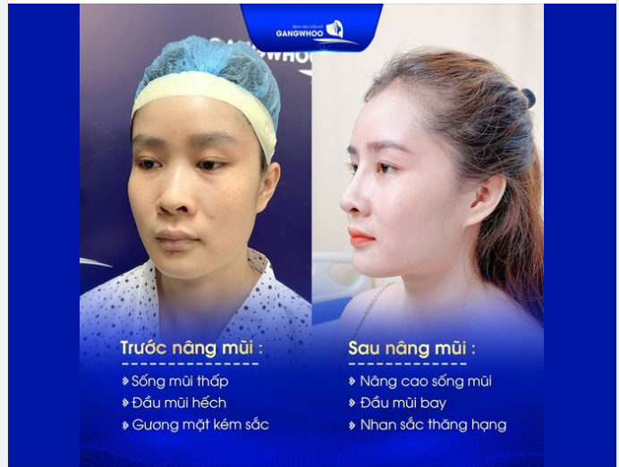 NÂNG MŨI BẠN SẼ THAY ĐỔI NHƯ THẾ NÀO?