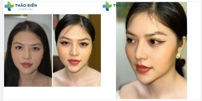 Now u see mê Ca nhấn mí sau 2 tháng quá xuất sắc tại Bệnh Viện Thảo Điền.