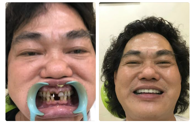 NGUYÊN NHÂN IMPLANT BỊ MẤT TÍCH HỢP XƯƠNG