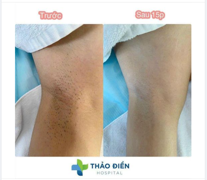 Các nàng đang gặp rắc rối với cách triệt lông truyền thống? Dù đã thử nhiều cách nhưng lông vẫn mọc dài và rậm?