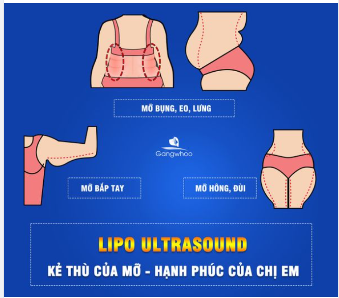 LIPO ULTRASOUND - 60 PHÚT ĐÁNH TAN MỠ MÀ KHÔNG CẦN PHẪU THUẬT