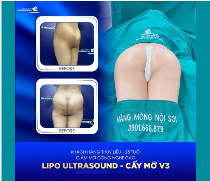 NÂNG VÒNG 3 BẰNG CẤY MỠ TỰ THÂN - ĐẸP VÀ AN TOÀN