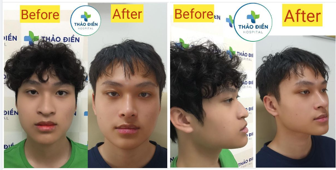NÂNG MŨI CHO EM TRAI TẠI BỆNH VIỆN THẢO ĐIỀN 