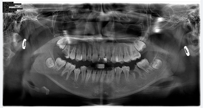 RĂNG KHÔN - RĂNG CẤM khác nhau như thế nào?
