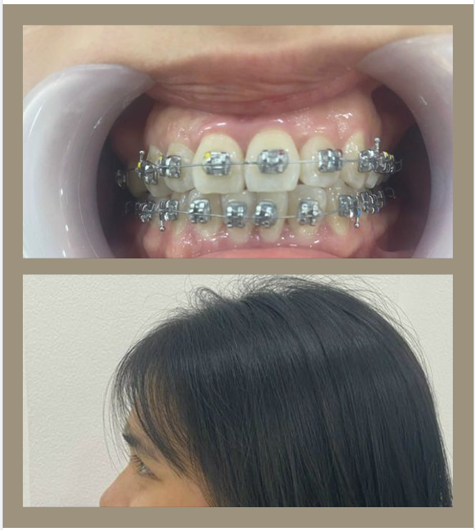 NHỮNG NGUYÊN NHÂN KHIẾN BẠN PHÂN VÂN KHI QUYẾT ĐỊNH NIỀNG RĂNG