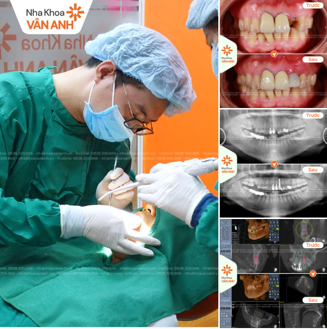 Gần tới ngày cưới người yêu cũ lại gãy răng và cái kết!