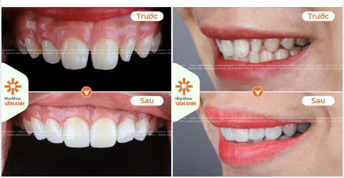 TẠM BIỆT HOÀN TOÀN RĂNG THƯA, HỞ KẼ VỚI CÔNG NGHỆ SMILE DESIGN
