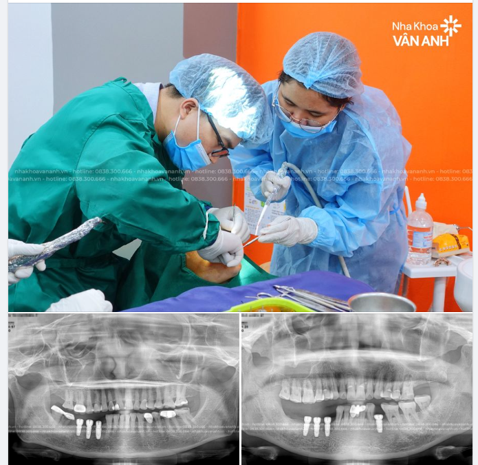TRỒNG RĂNG IMPLANT KHÔNG ĐAU, KHÔNG RẠCH VẠT LỢI VỚI CÔNG NGHỆ HI-SAFE ĐỘC QUYỀN!