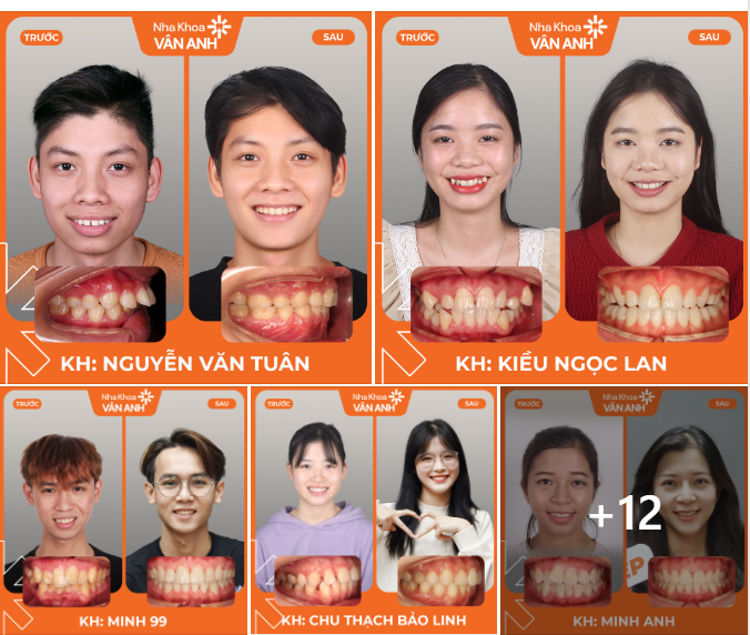 TẠI SAO RẤT NHIỀU KHÁCH HÀNG LỰA CHỌN NHA KHOA VÂN ANH ĐỂ NIỀNG RĂNG