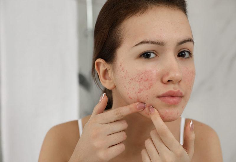 Chi phí trị sẹo bao nhiêu tiền? Bảng giá trị sẹo mới nhất 2023