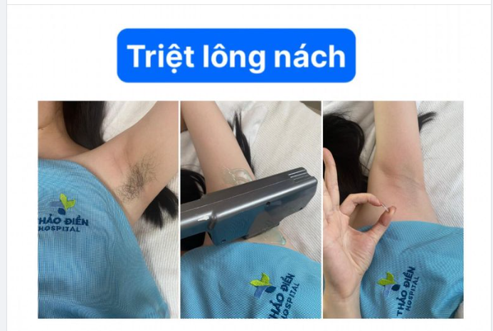 FEEDBACK XỊN XÒ KHÔNG NÓNG KHÔNG ĐAU KHI TRIỆT LÔNG TẠI NHÀ THẢO ĐIỀN BEAUTY CENTER