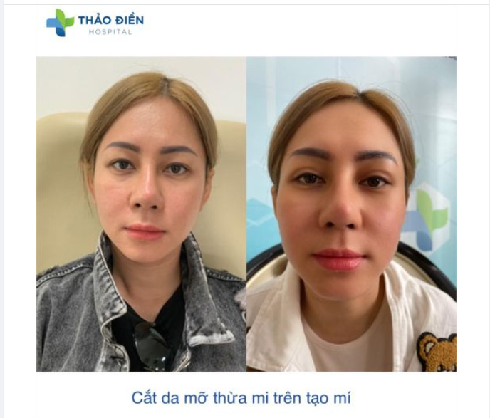 CẮT MÍ MẮT SAU 30 NGÀY - SẸO ĐI ĐÂU RỒI