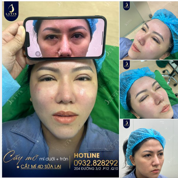 Hoàn thành ca trẻ hóa mắt kết hợp cắt mí 4D sửa lại cho chị gái
