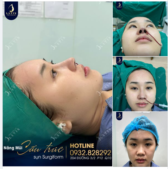 "Bác sĩ ơi, em muốn dáng mũi cao và thon hơn..."Không gì là không thể với các bác sĩ tại Latin.