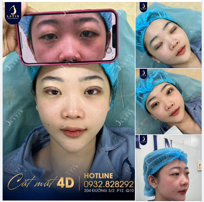 Chúc mừng em gái sở hữu đôi mắt 2 mí to đều tự nhiên như đúng mong ước