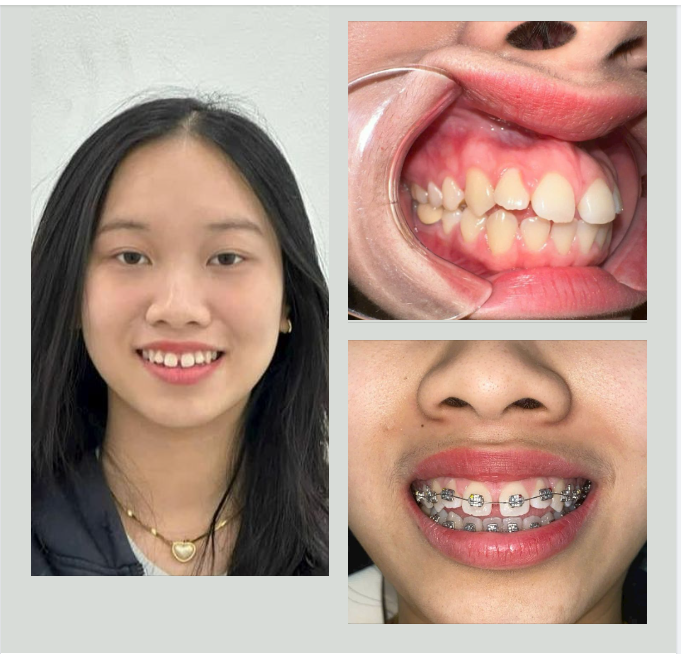 Niềng răng cho bạn Tân sinh viên