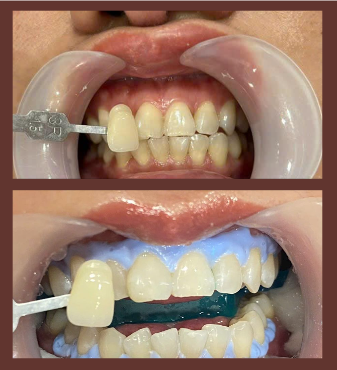 NỤ CƯỜI TRẮNG SÁNG VỚI TẨY TRẮNG RĂNG