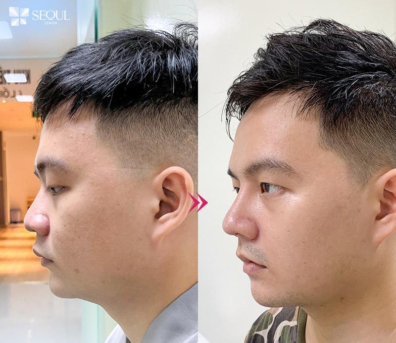 Nâng mũi L Line cho nam là gì? Những điều cần lưu ý