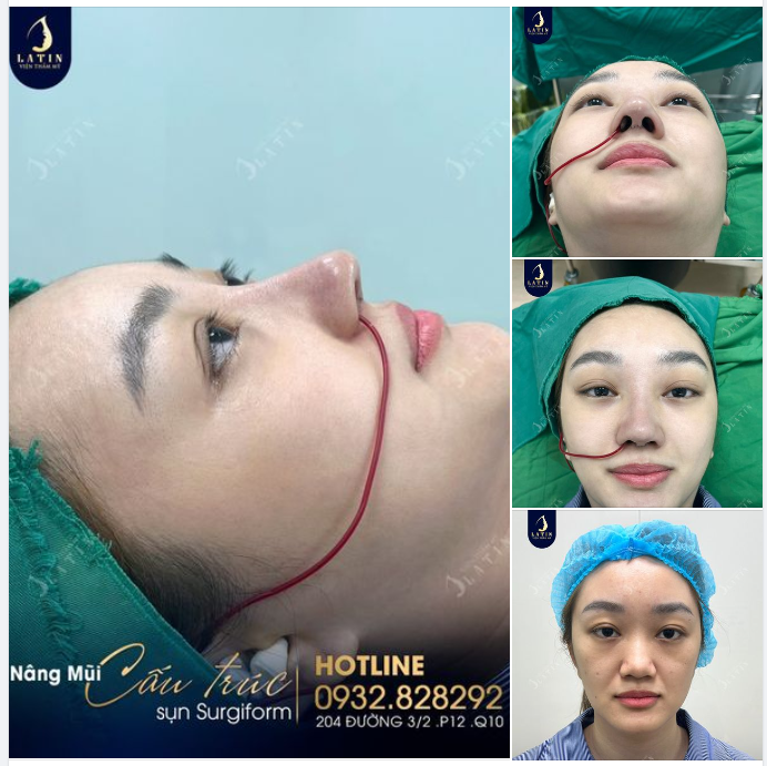 Kết quả nâng mũi cấu trúc sóng surgiform kết hợp chỉnh vách ngăn, chỉnh ống mũi cho em gái sáng nay