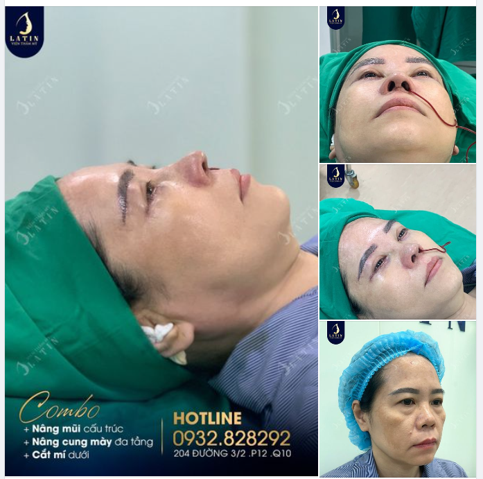 Chị gái chốt ngay combo Nâng mũi + Nâng cung mày ngay sau khi được tư vấn