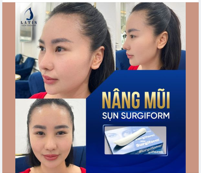 ƯU ĐIỂM VƯỢT TRỘI CỦA SỤN NÂNG MŨI SURGIFORM