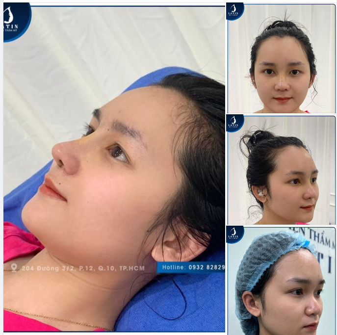 MŨI CẤU TRÚC 10 NGÀY ĐẸP XUẤT SẮC